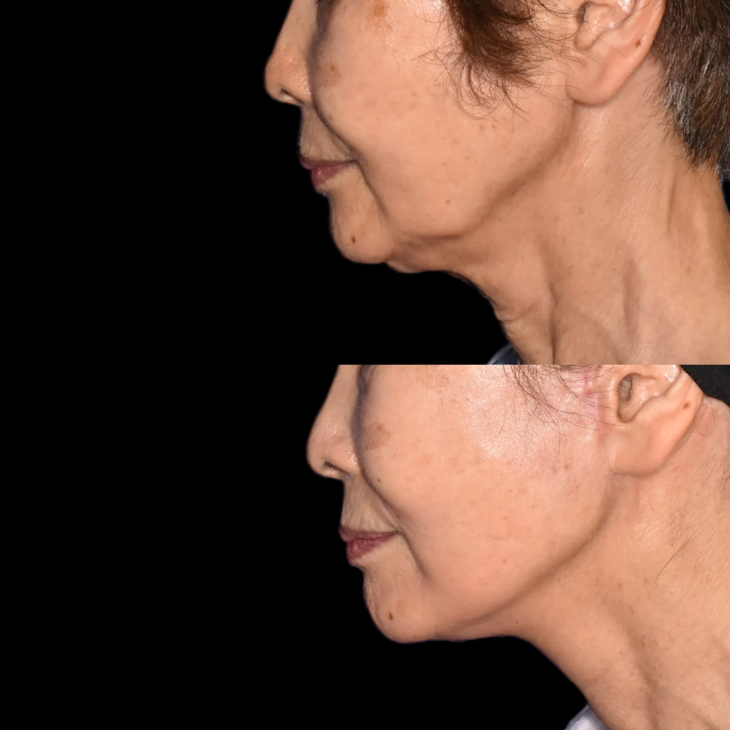 面部提升术案例模特招募-Looking For Case Model for Face Lift Surgery