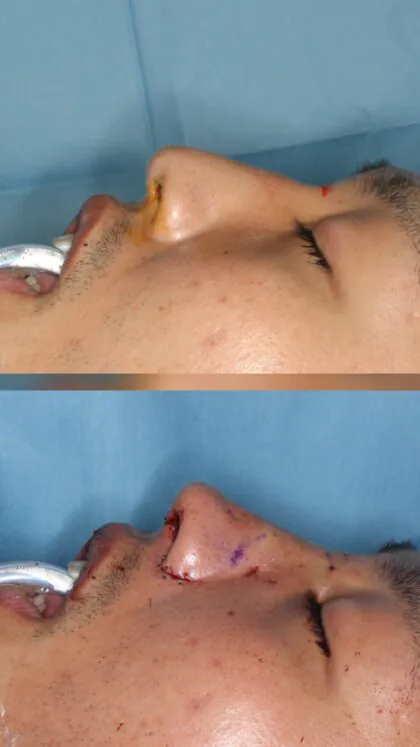 Reshaping men’s noses