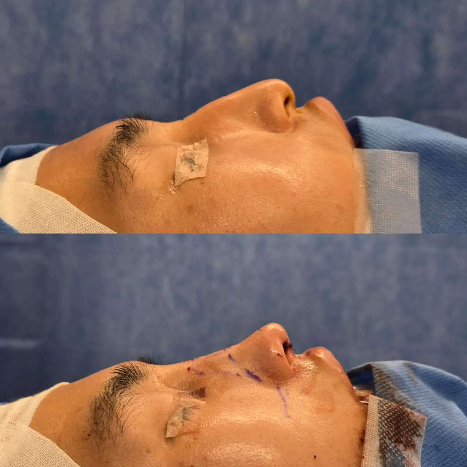 Men’s Rhinoplasty – Hump nose, drooping nose case