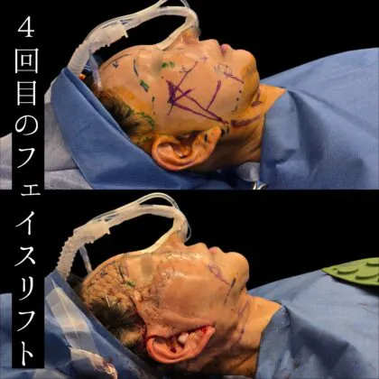 Deep Plane Facelift as fourth facelift surgery – patient originally from Singapore