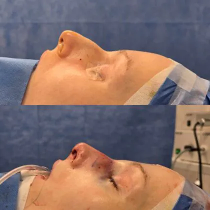 Hump Reduction – Preservation Rhinoplasty for Polish female patient’s nose reduction