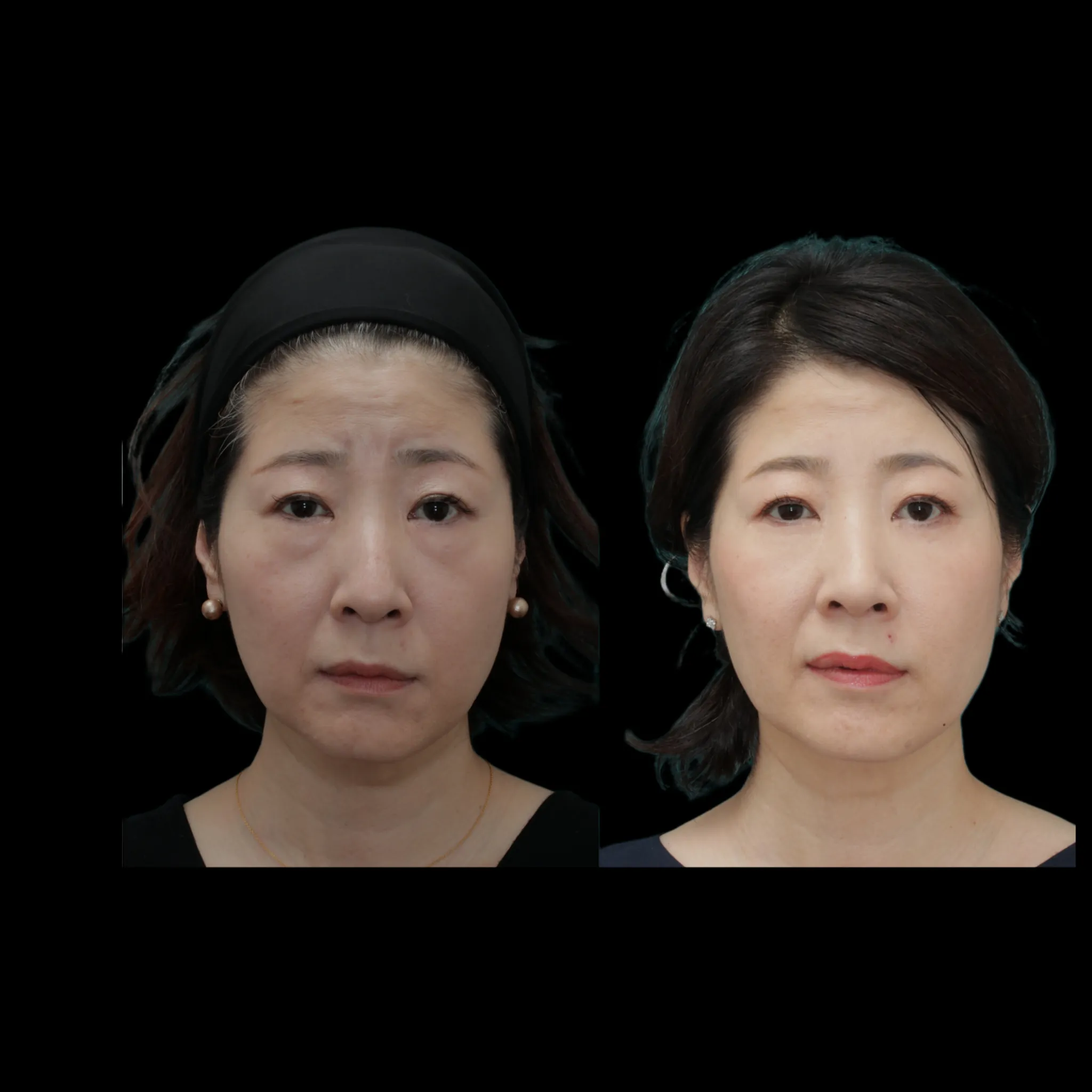 Eye Bags Removal – Case Study of Female Patient in her 50s