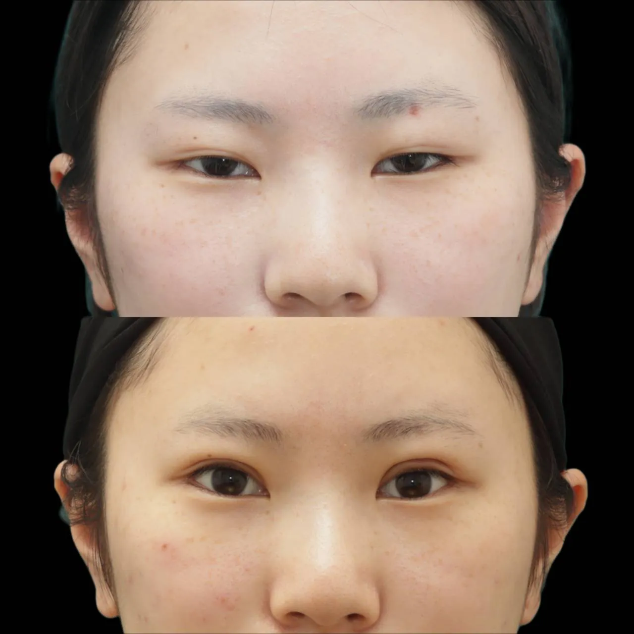 Double Eyelid Surgery – Creating Natural and Beautiful Double Eyelids