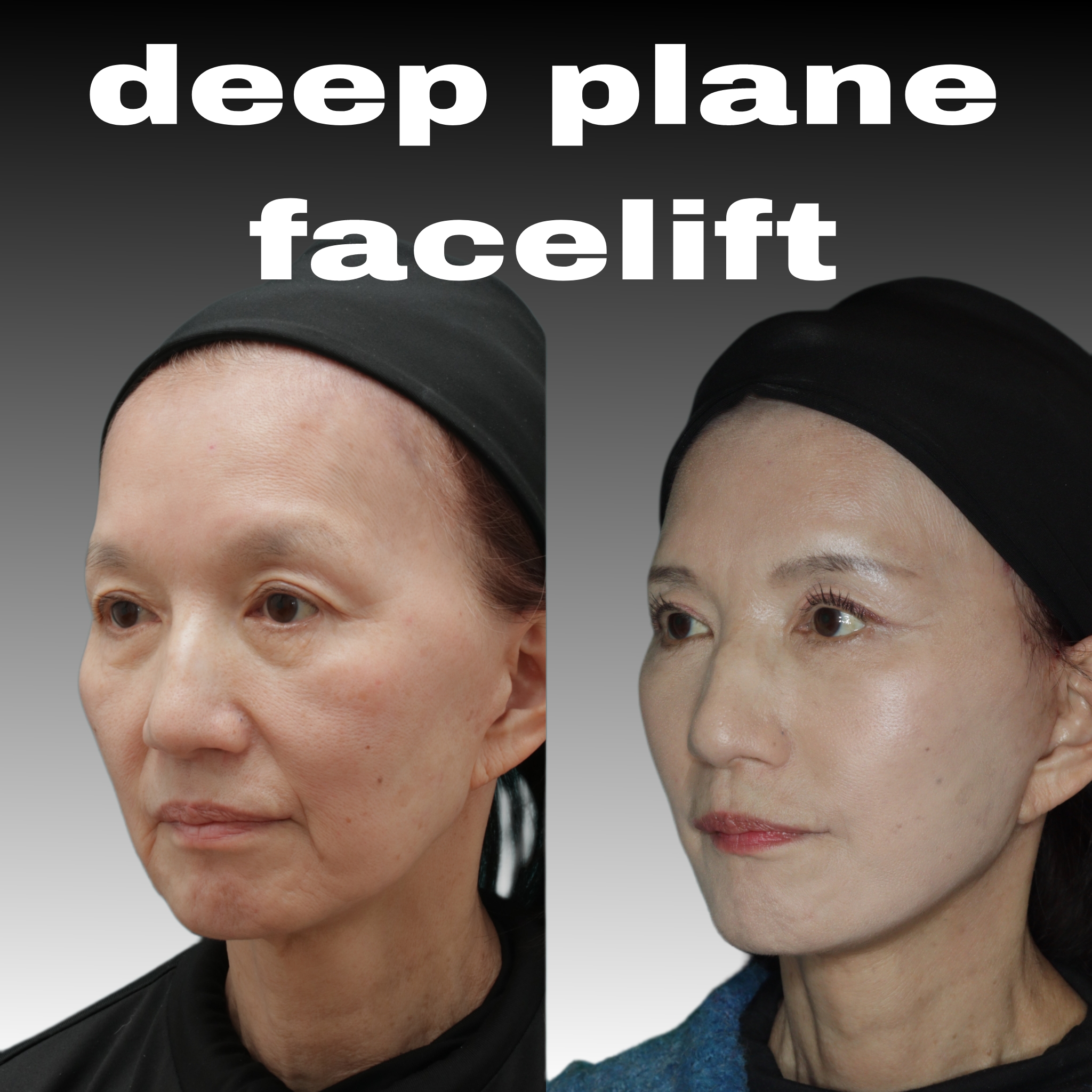 フェイスリフト手術 2か月経過 横から | 中尾形成外科