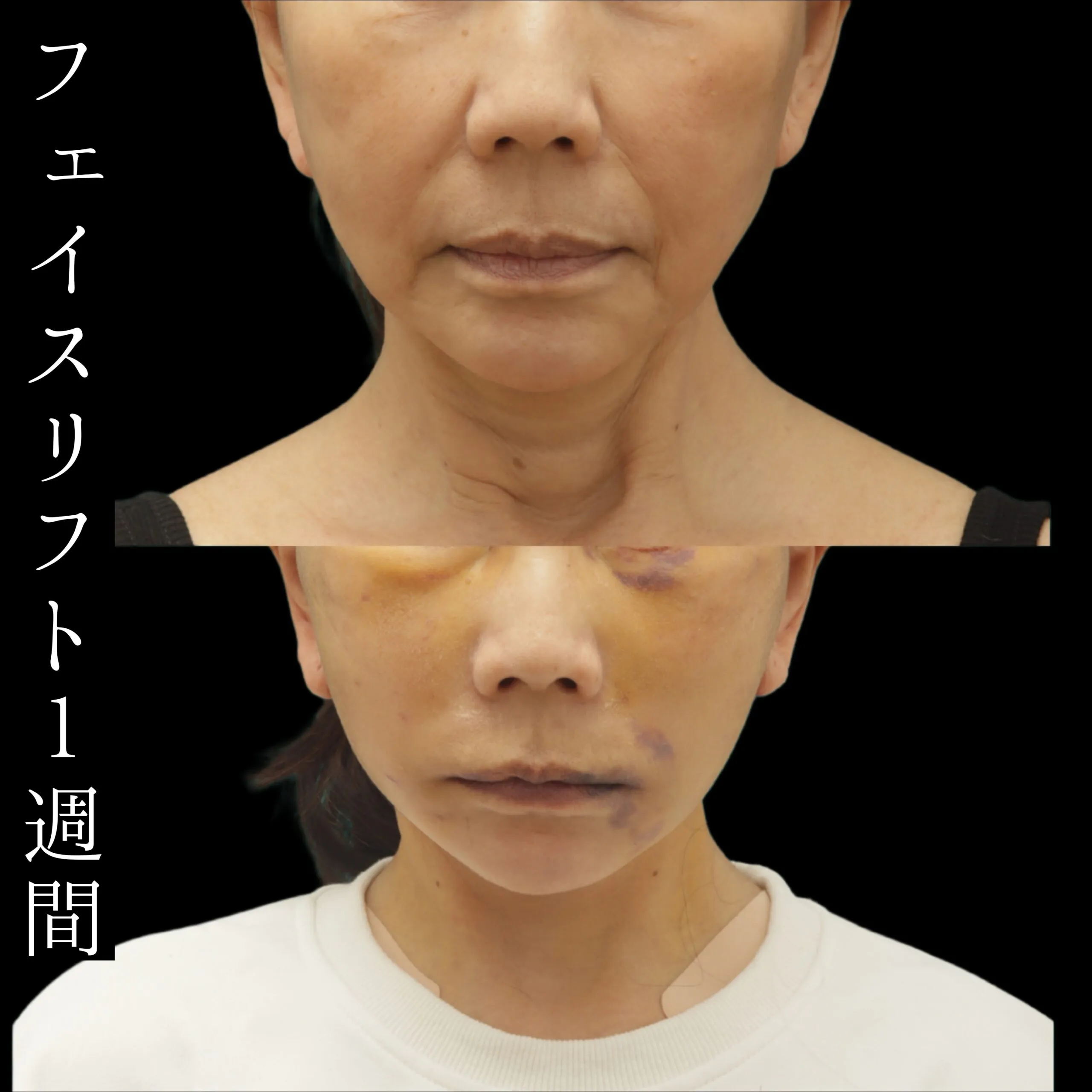 4回目のフェイスリフトの術後1週間の経過　　シンガポール出身の女性の症例です。