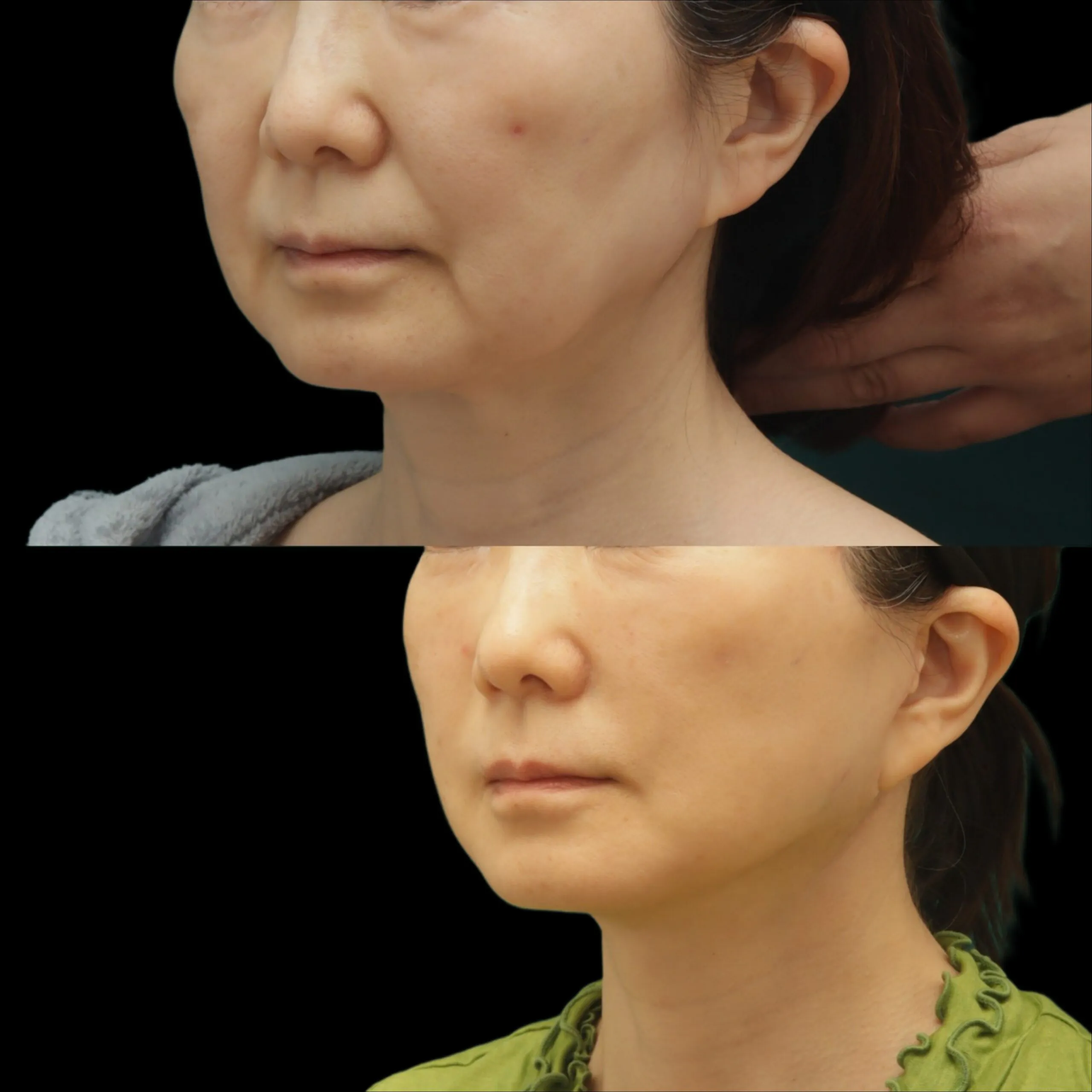 ほうれい線とマリオネットラインを改善する ディーププレーンフェイスリフト