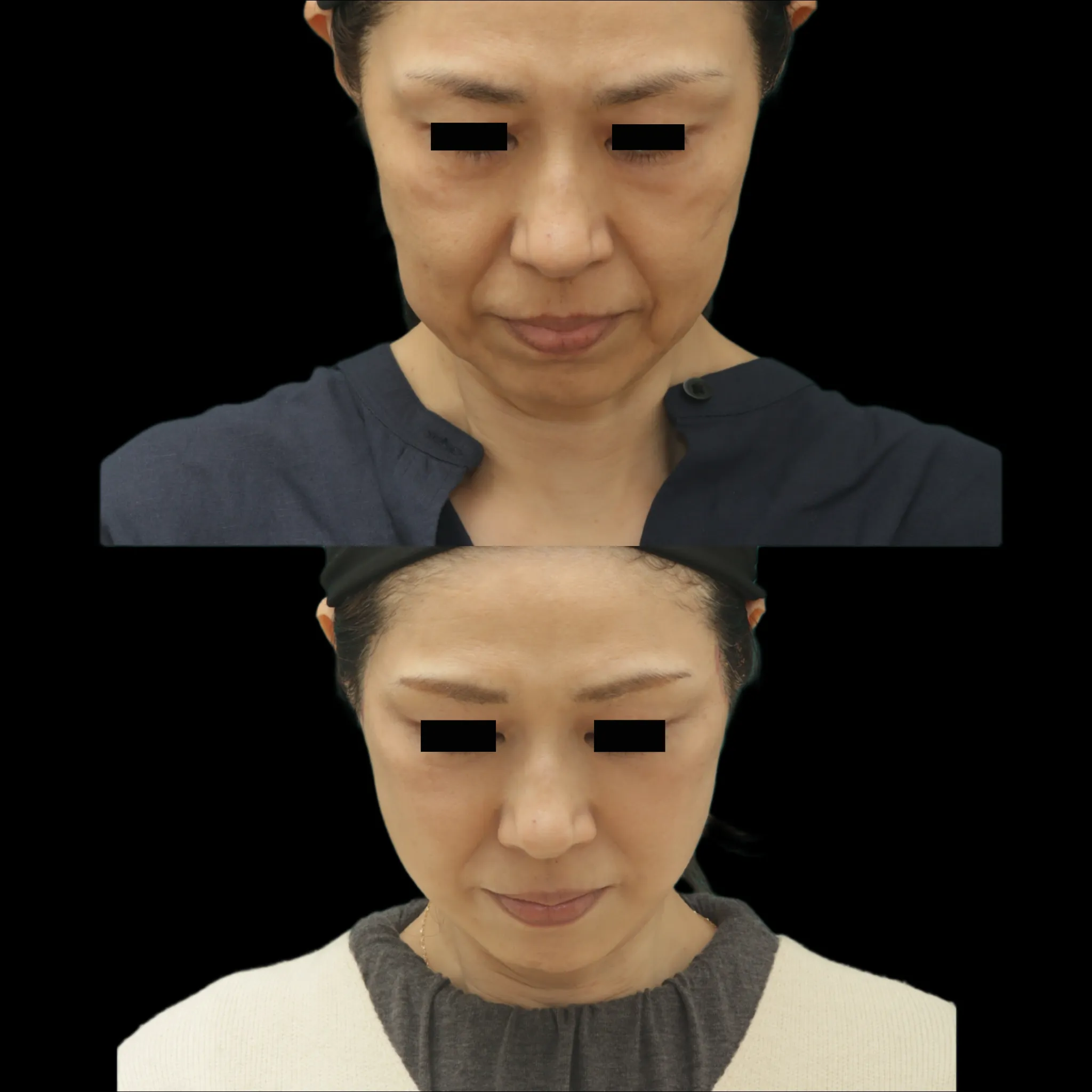 ディーププレーンフェイスリフト　下を向いても美しく