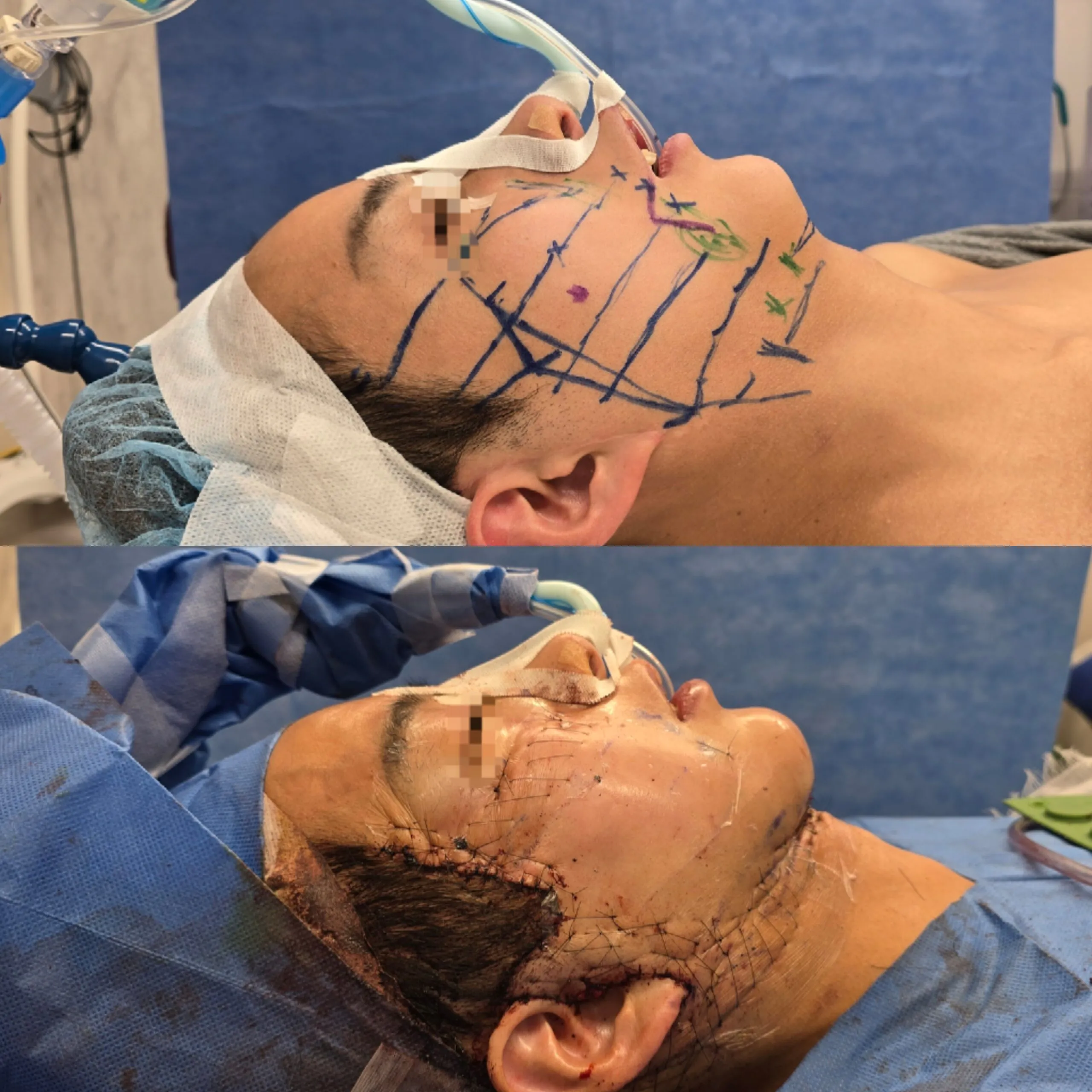 韓国で行われたフェイスネックリフト、ペリカン手術をもう一度当院で行いました。