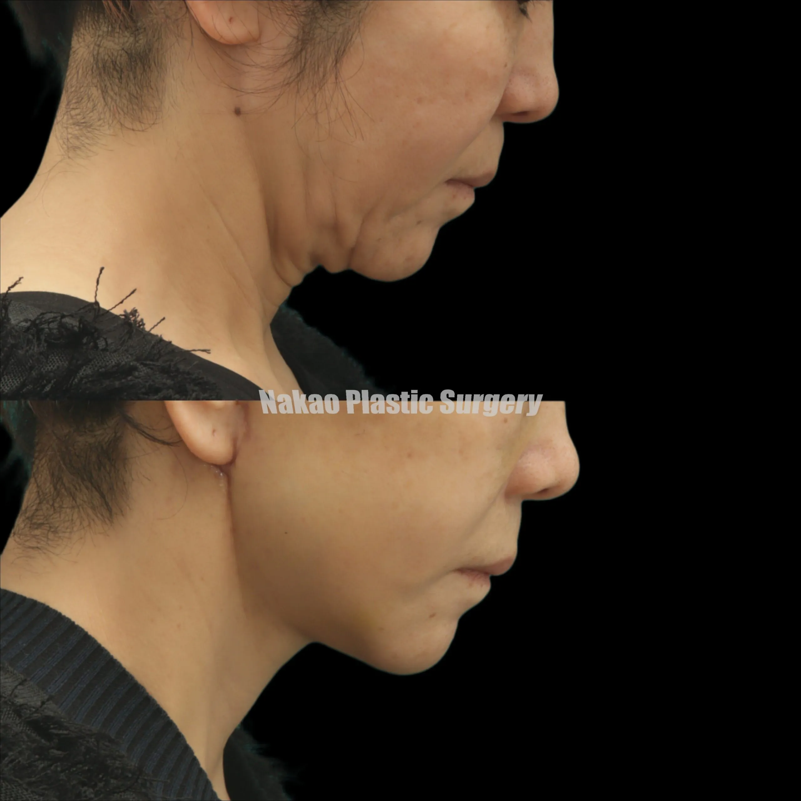 下を向いたときも美しくありたい ディーププレーンフェイスリフトを行いました。