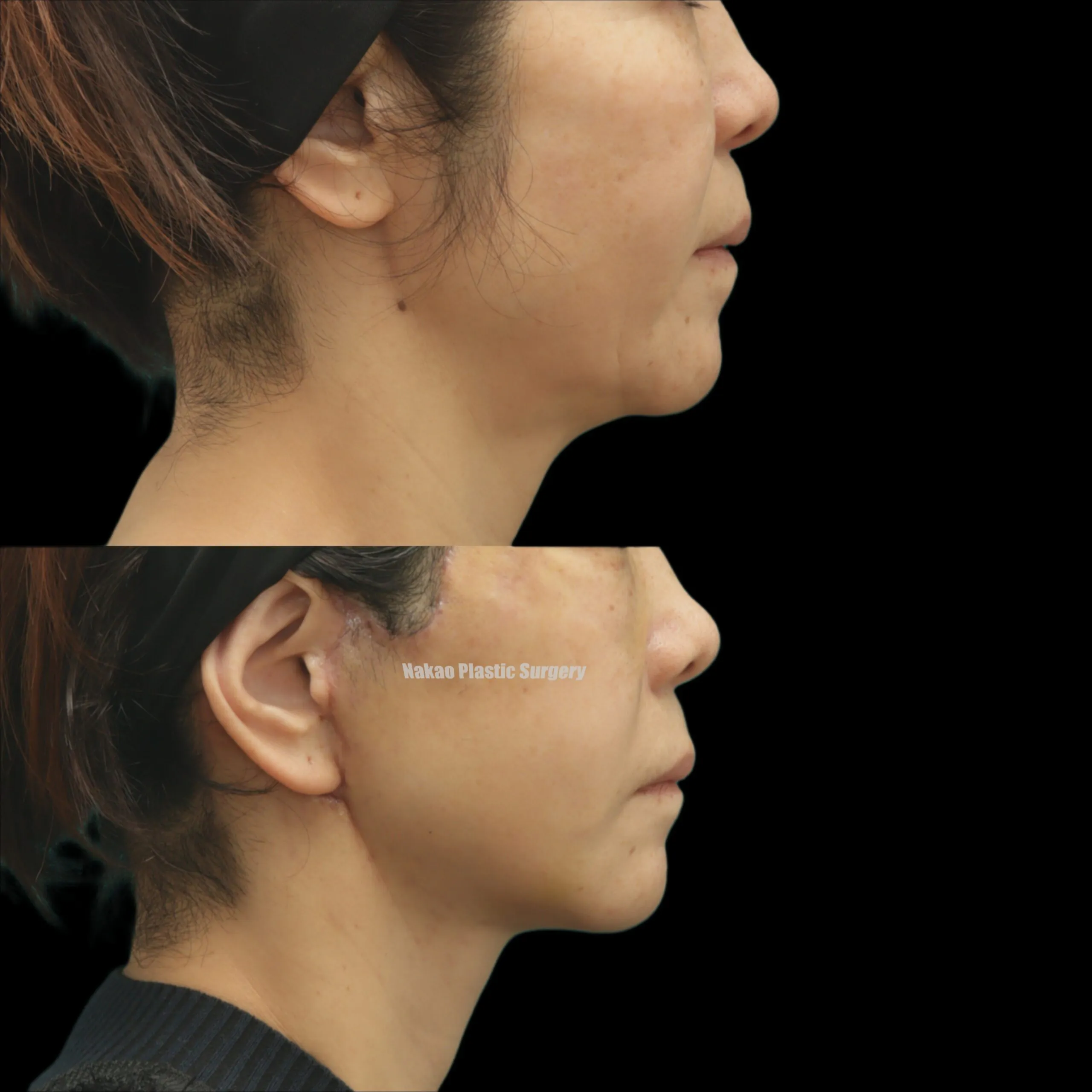 顎下腺の陰影を消す ディーププレーンフェイスリフト